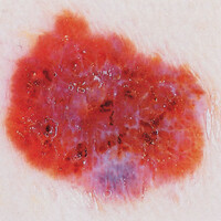 Δερματοσκόπιο Heine Delta 20T χωρίς Κλίμακα