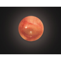 Σετ Ωτοσκοπίου BETA®200 LED Heine | 2.5V