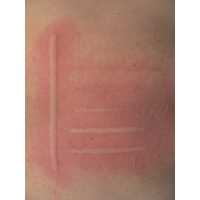 Δερμογραφόμετρο FricTest®