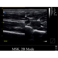 Φορητός Έγχρωμος Υπέρηχος Chison ECO5 με Doppler.