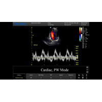 Φορητός Έγχρωμος Υπέρηχος Chison ECO5 με Doppler.