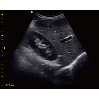 Ασπρόμαυρος Φορητός Υπέρηχος Chison ECO1 με 2 Θύρες