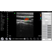 Ασύρματος Διαγνωστικός Υπέρηχος Sonostar 3.5-5.0MHz Convex Probe Color Doppler