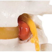 Πρόπλασμα Οσφυϊκών Σπονδύλων με Πρόπτωση Δίσκου