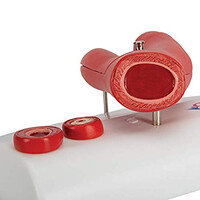 Πρόπλασμα Αρτηριοσκλήρυνσης