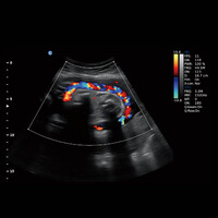 Έγχρωμος Φορητός Υπέρηχος Chison Ebit30