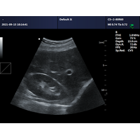 Φορητός Υπέρηχος CONTEC CMS600P2 Plus | Convex Probe 3.5MHz ή Linear Probe 7.5MHz