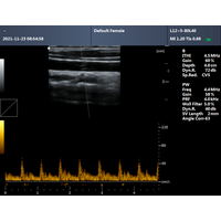 Φορητός Υπέρηχος CONTEC CMS600P2 Plus | Convex Probe 3.5MHz ή Linear Probe 7.5MHz