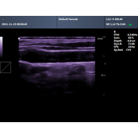 Φορητός Υπέρηχος CONTEC CMS600P2 Plus | Convex Probe 3.5MHz ή Linear Probe 7.5MHz