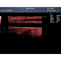 Φορητός Υπέρηχος CONTEC CMS600P2 Plus | Convex Probe 3.5MHz ή Linear Probe 7.5MHz