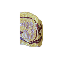 Πρόπλασμα Παχυσαρκίας Ισχίων