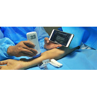 Ασύρματος Διαγνωστικός Υπέρηχος Sonostar 7.5–10MHz Linear 128 Elements BW