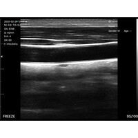 Ασύρματος Διαγνωστικός Υπέρηχος Sonostar 7.5–10MHz Linear 128 Elements BW