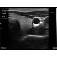 Ασύρματος Διαγνωστικός Υπέρηχος Sonostar 7.5–10MHz Linear 128 Elements BW