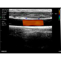 Ασύρματος Διαγνωστικός Υπέρηχος Sonostar 7.5-10MHz Linear 128 Elements Color Doppler