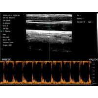Ασύρματος Διαγνωστικός Υπέρηχος Sonostar 7.5-10MHz Linear 128 Elements Color Doppler
