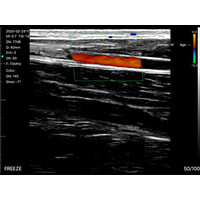 Ασύρματος Διαγνωστικός Υπέρηχος Sonostar 7.5-10MHz Linear 128 Elements Color Doppler