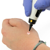 Φορητό Στυλό Κρυοπηξίας Cryopen X+ (Νέο Μοντέλο)