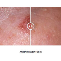 Φορητό Στυλό Κρυοπηξίας Cryopen XP (Νέο Μοντέλο)