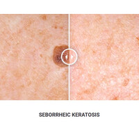 Φορητό Στυλό Κρυοπηξίας Cryopen XP (Νέο Μοντέλο)