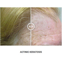 Φορητό Στυλό Κρυοπηξίας Cryopen X+ (Νέο Μοντέλο)