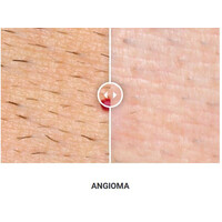 Φορητό Στυλό Κρυοπηξίας Cryopen X+ (Νέο Μοντέλο)