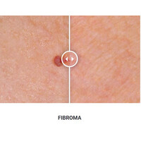 Φορητό Στυλό Κρυοπηξίας Cryopen X+ (Νέο Μοντέλο)