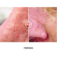 Φορητό Στυλό Κρυοπηξίας Cryopen X+ (Νέο Μοντέλο)