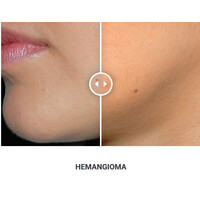 Φορητό Στυλό Κρυοπηξίας Cryopen X+ (Νέο Μοντέλο)