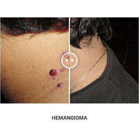 Φορητό Στυλό Κρυοπηξίας Cryopen XP (Νέο Μοντέλο)