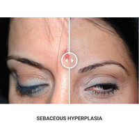 Φορητό Στυλό Κρυοπηξίας Cryopen X+ (Νέο Μοντέλο)