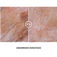 Φορητό Στυλό Κρυοπηξίας Cryopen X+ (Νέο Μοντέλο)