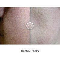 Φορητό Στυλό Κρυοπηξίας Cryopen X+ (Νέο Μοντέλο)