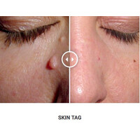 Φορητό Στυλό Κρυοπηξίας Cryopen X+ (Νέο Μοντέλο)