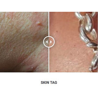 Φορητό Στυλό Κρυοπηξίας Cryopen X+ (Νέο Μοντέλο)