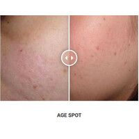 Φορητό Στυλό Κρυοπηξίας Cryopen XP (Νέο Μοντέλο)