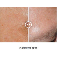 Φορητό Στυλό Κρυοπηξίας Cryopen XP (Νέο Μοντέλο)