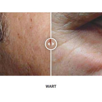 Φορητό Στυλό Κρυοπηξίας Cryopen X+ (Νέο Μοντέλο)