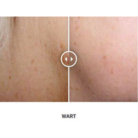 Φορητό Στυλό Κρυοπηξίας Cryopen X+ (Νέο Μοντέλο)