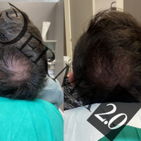 Derma-Hair by Derma 2.0® Ενισχυτικό Θεραπευτικό Διάλυμα Κατά της Τριχόπτωσης | 5τμχ. x 5ml