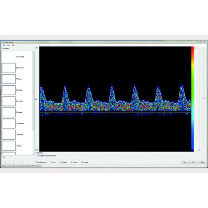 Dopplex® Vascular Reporter Software Λογισμικό Αγγειολογικών Doppler Huntleigh